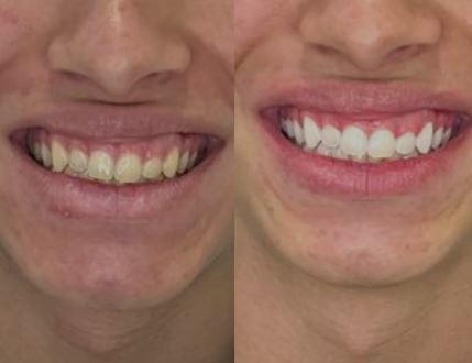 Clareamento Dental